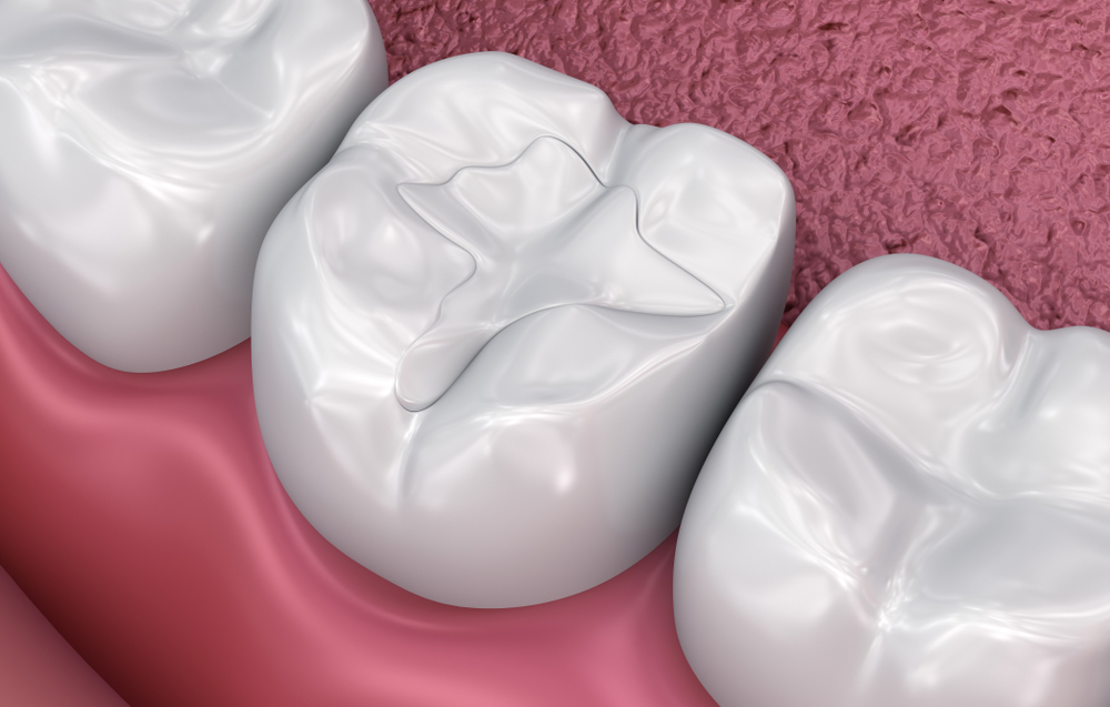 dental filling example